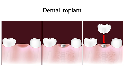 Implants