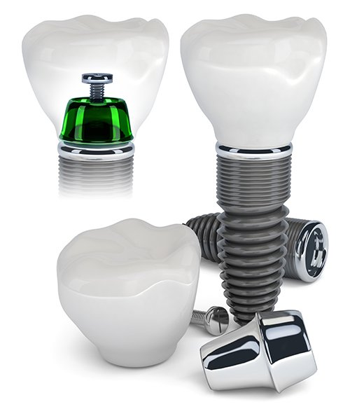Implants